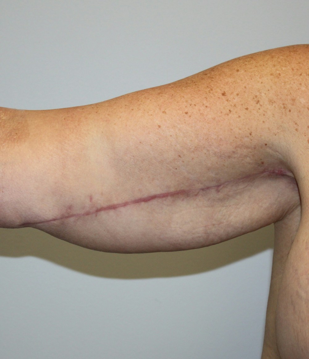 Arm Lift Before & After Gallery - Patient 62070233 - Image 2