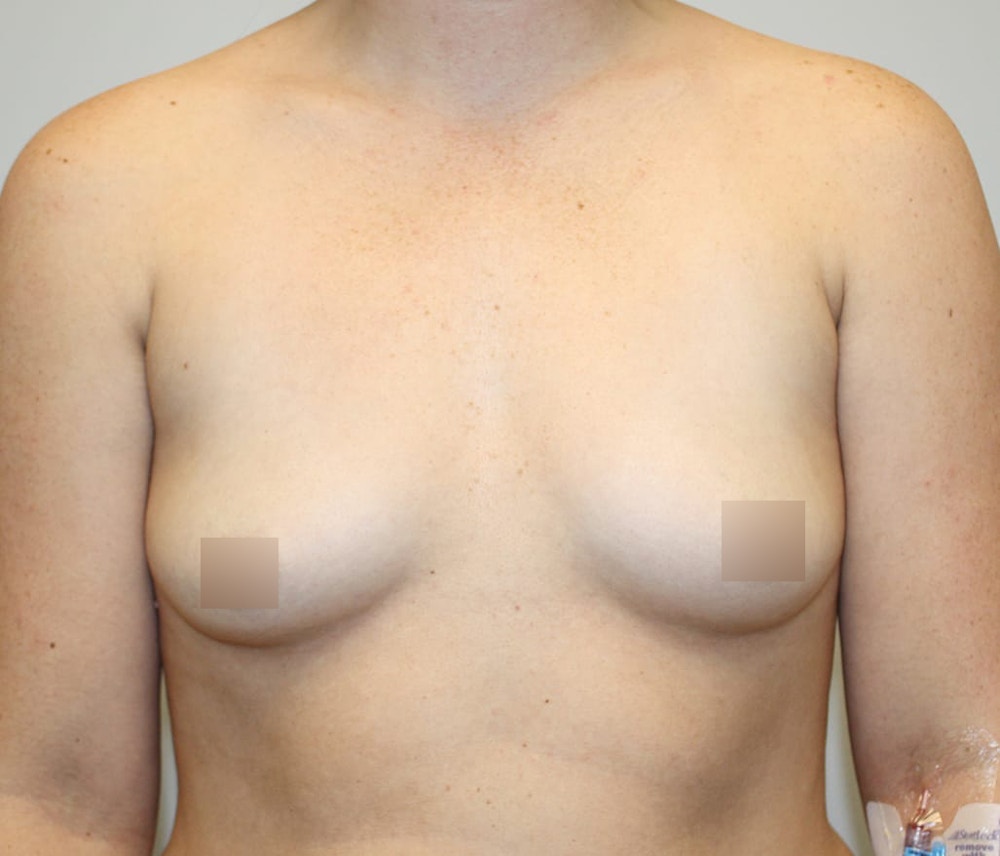 Breast Augmentation Before & After Gallery - Patient 62074037 - Image 1