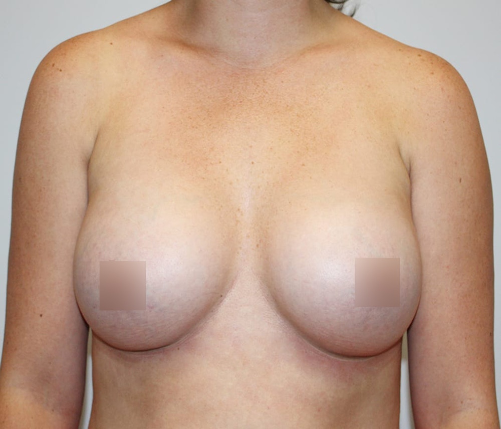 Breast Augmentation Before & After Gallery - Patient 62074037 - Image 2