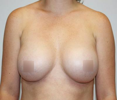 Breast Augmentation Before & After Gallery - Patient 62074037 - Image 2