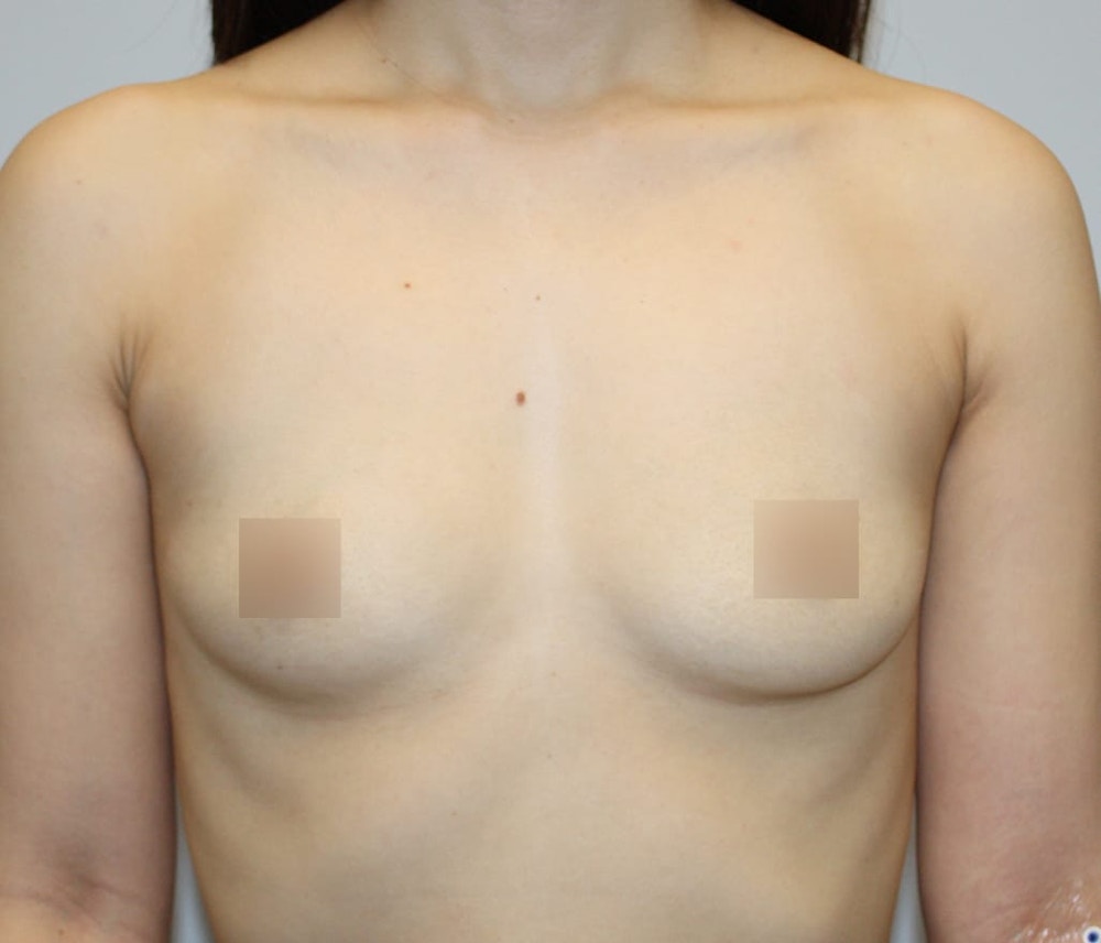Breast Augmentation Before & After Gallery - Patient 62078692 - Image 1