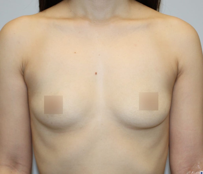 Breast Augmentation Before & After Gallery - Patient 62078692 - Image 1