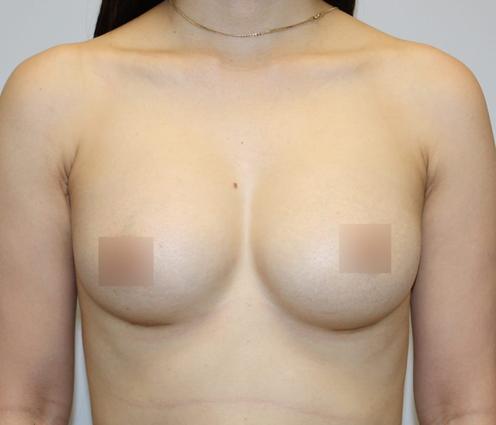 Breast Augmentation Before & After Gallery - Patient 62078692 - Image 2