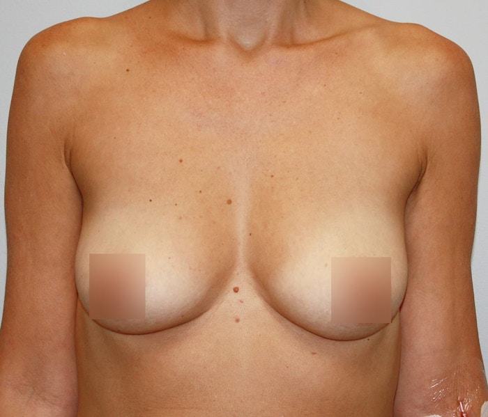 Breast Augmentation Before & After Gallery - Patient 62086673 - Image 1
