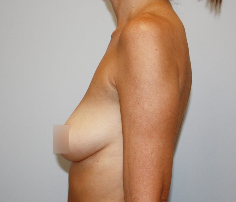 Breast Augmentation Before & After Gallery - Patient 62086673 - Image 3