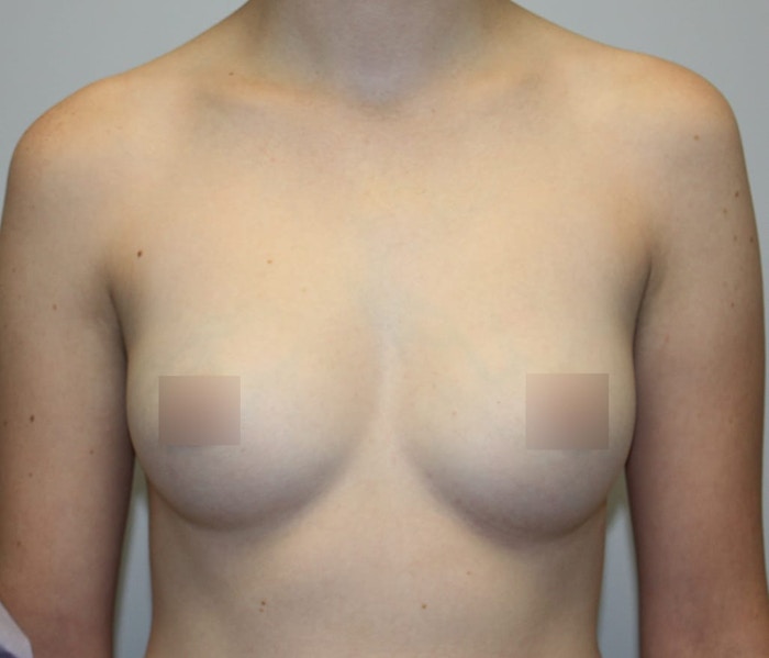 Breast Augmentation Before & After Gallery - Patient 62086672 - Image 1
