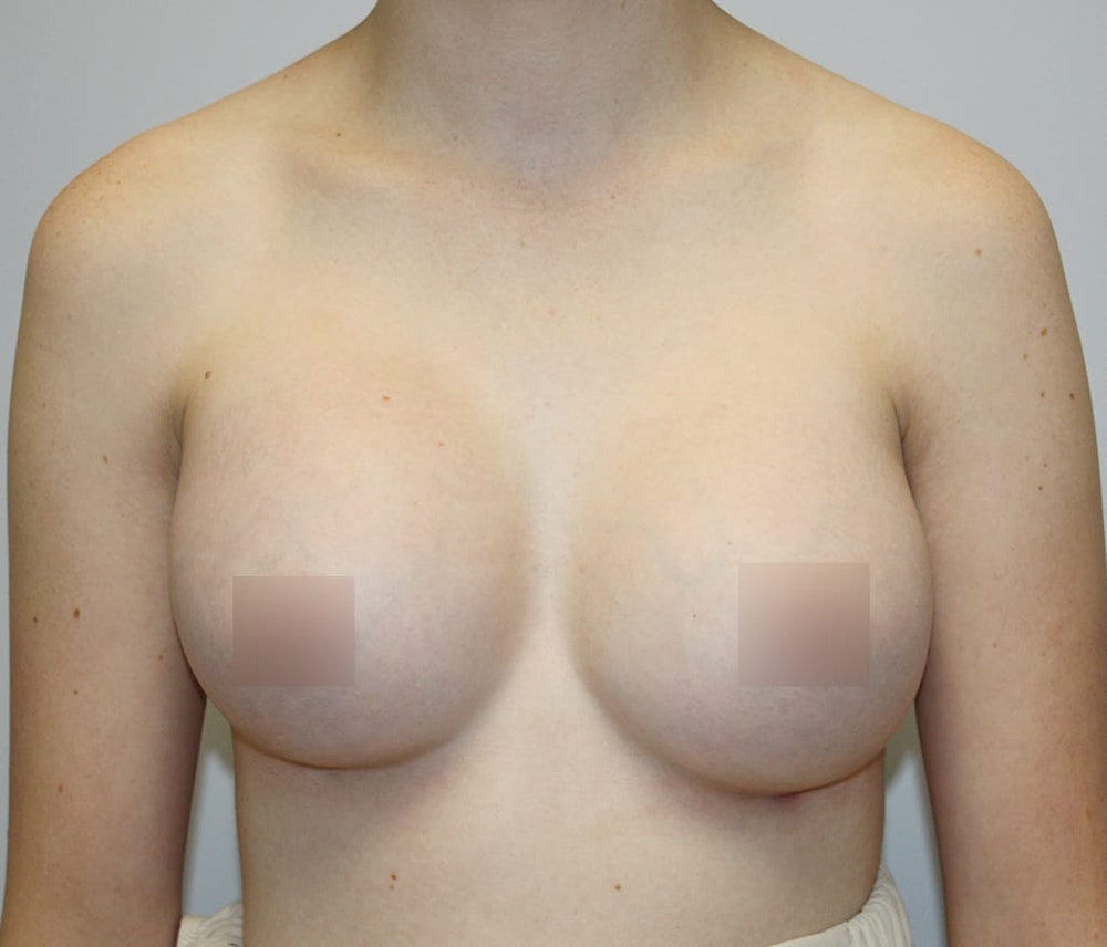 Breast Augmentation Before & After Gallery - Patient 62086672 - Image 2