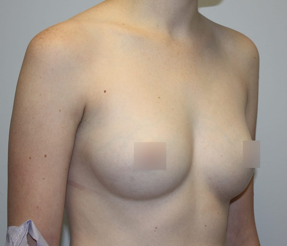 Breast Augmentation Before & After Gallery - Patient 62086672 - Image 3