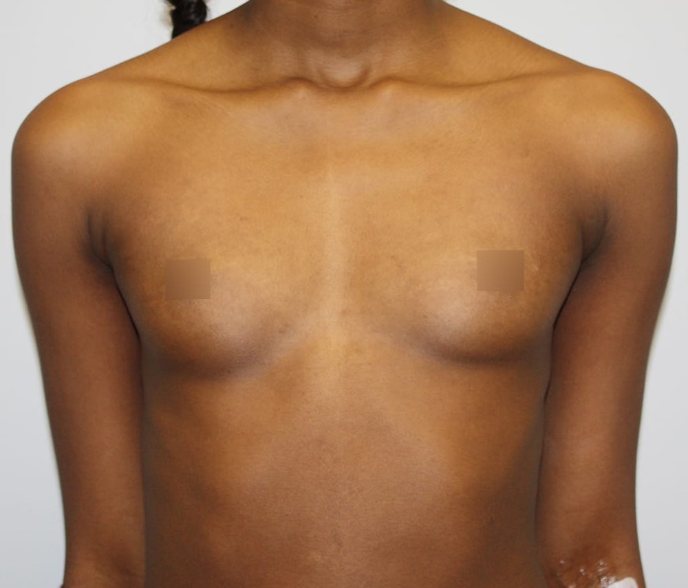 Breast Augmentation Before & After Gallery - Patient 62086698 - Image 1