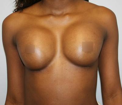 Breast Augmentation Before & After Gallery - Patient 62086698 - Image 2