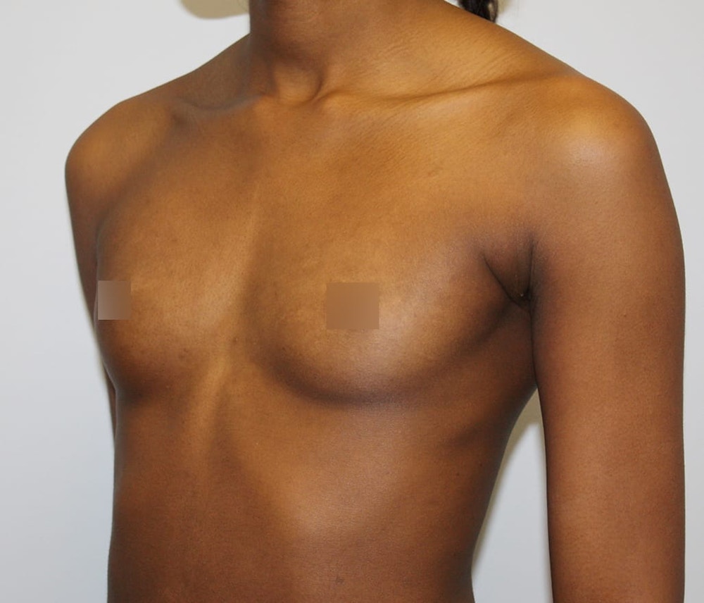 Breast Augmentation Before & After Gallery - Patient 62086698 - Image 3