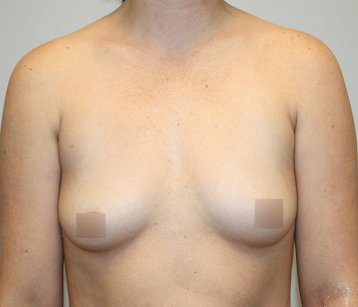 Breast Augmentation Before & After Gallery - Patient 62086719 - Image 1