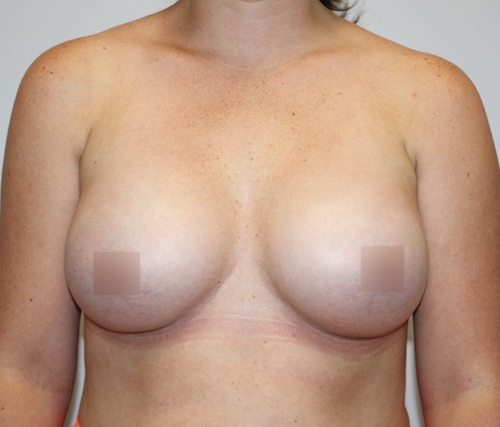 Breast Augmentation Before & After Gallery - Patient 62086719 - Image 2