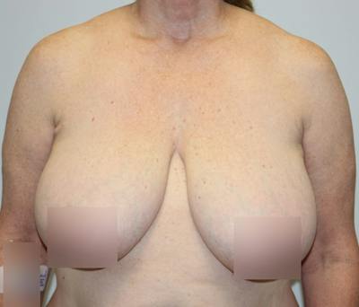 Breast Reduction Before & After Gallery - Patient 62086743 - Image 1