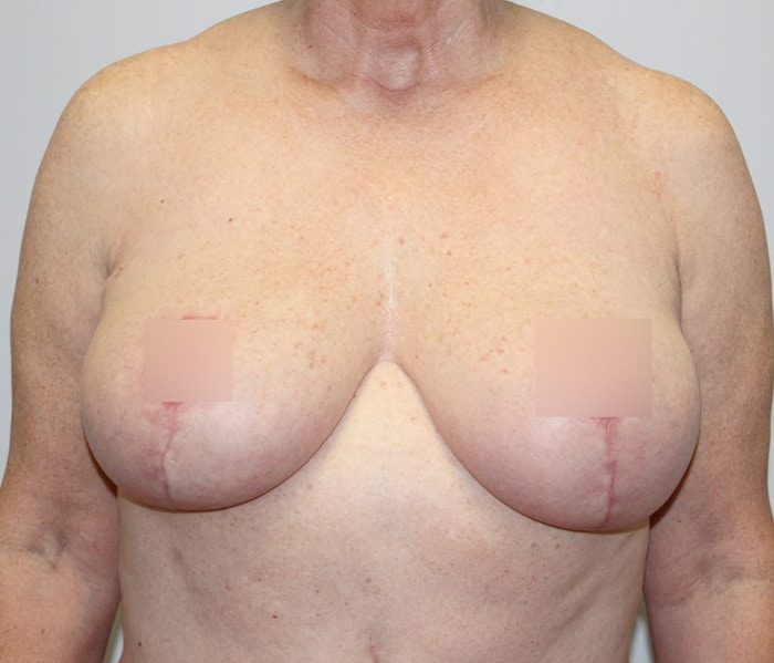 Breast Reduction Before & After Gallery - Patient 62086743 - Image 2