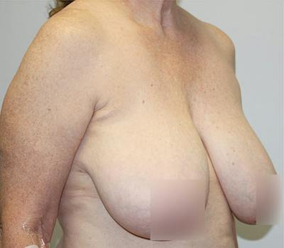 Breast Reduction Before & After Gallery - Patient 62086743 - Image 3
