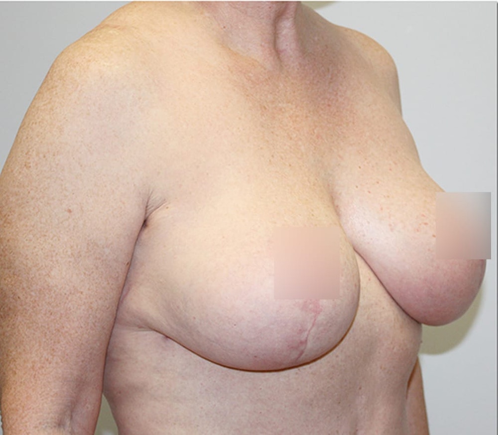 Breast Reduction Before & After Gallery - Patient 62086743 - Image 4