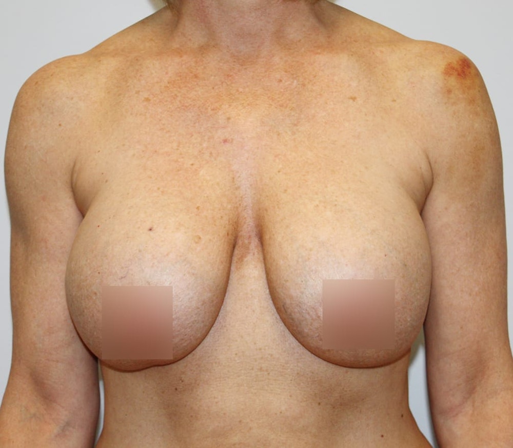 Breast Lift Before & After Gallery - Patient 62091222 - Image 1