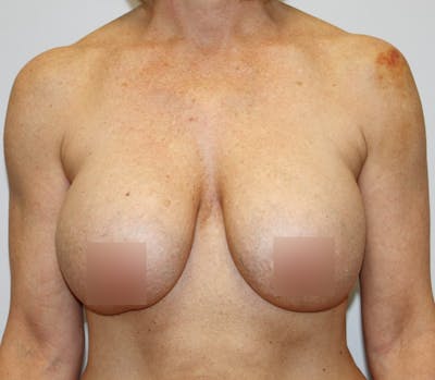Breast Lift Before & After Gallery - Patient 62091222 - Image 1