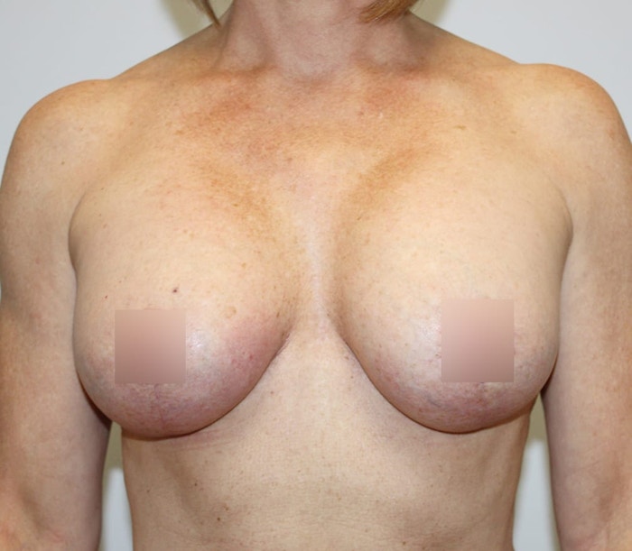 Breast Lift Before & After Gallery - Patient 62091222 - Image 2