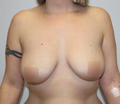 Breast Lift Before & After Gallery - Patient 62091258 - Image 1