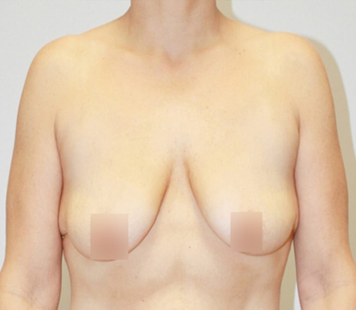 Breast Lift Before & After Gallery - Patient 62116134 - Image 1