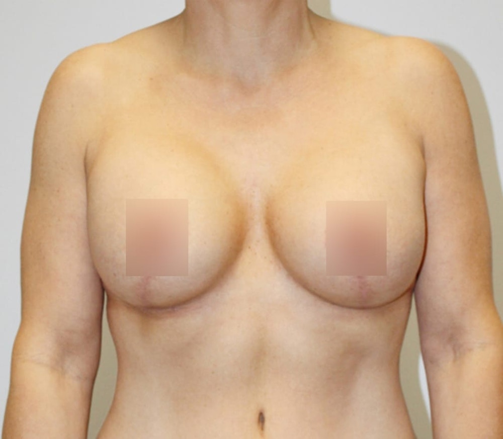 Breast Lift Before & After Gallery - Patient 62116134 - Image 2