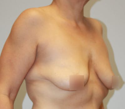 Breast Lift Before & After Gallery - Patient 62116134 - Image 3
