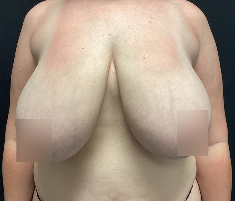 Breast Reduction Before & After Gallery - Patient 62142012 - Image 1