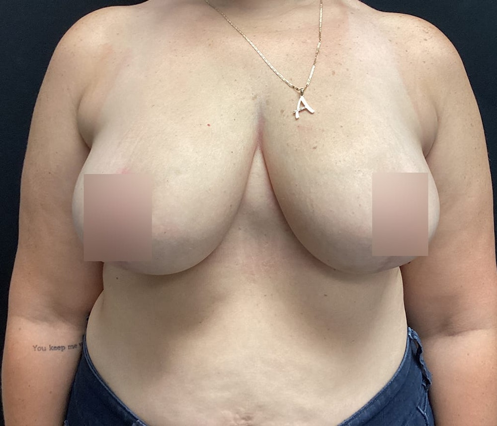 Breast Reduction Before & After Gallery - Patient 62142012 - Image 2