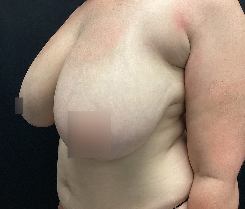 Breast Reduction Before & After Gallery - Patient 62142012 - Image 3