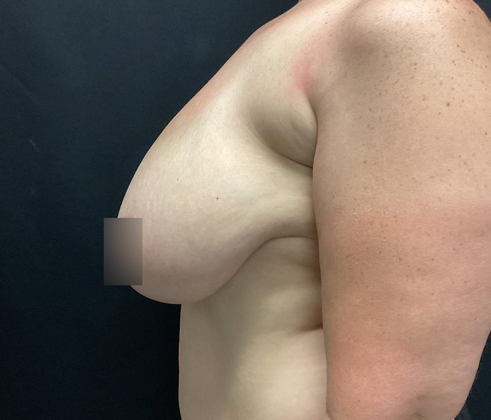 Breast Reduction Before & After Gallery - Patient 62142012 - Image 5