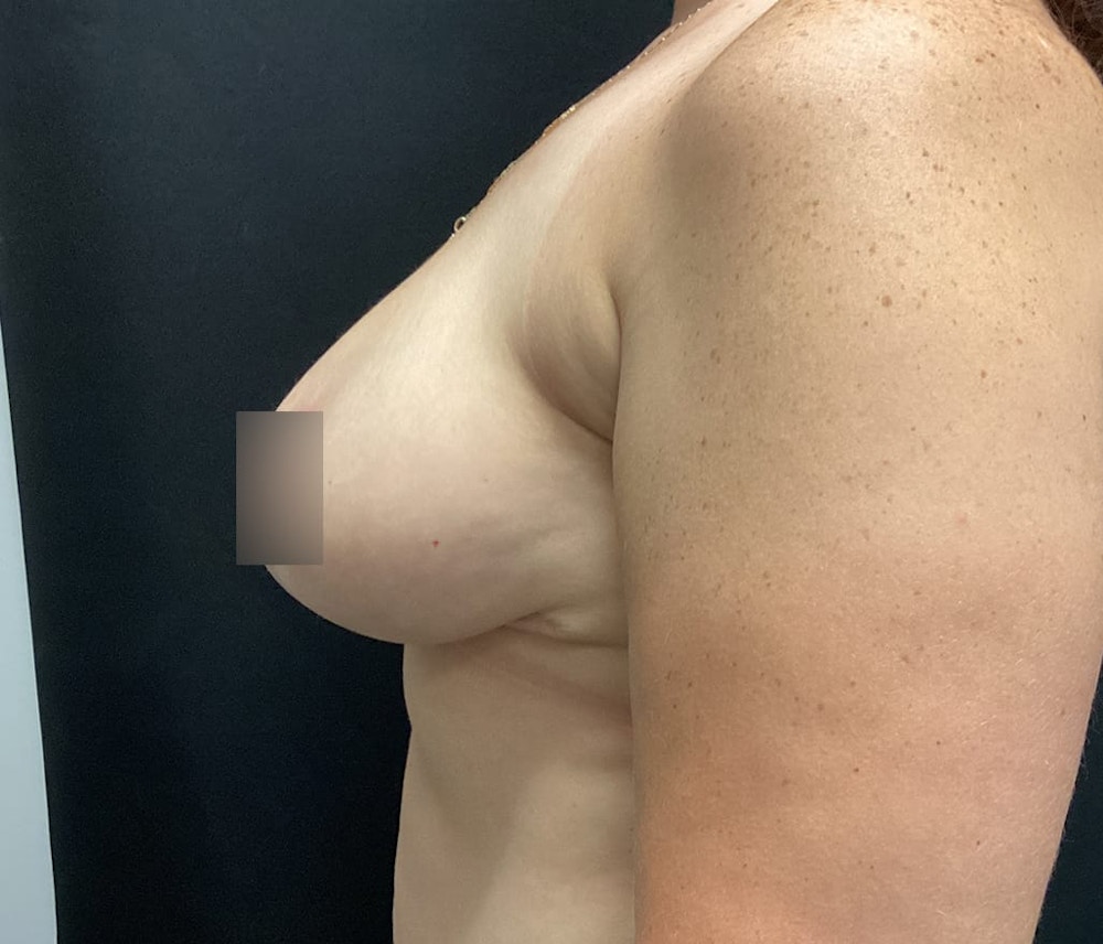 Breast Reduction Before & After Gallery - Patient 62142012 - Image 6