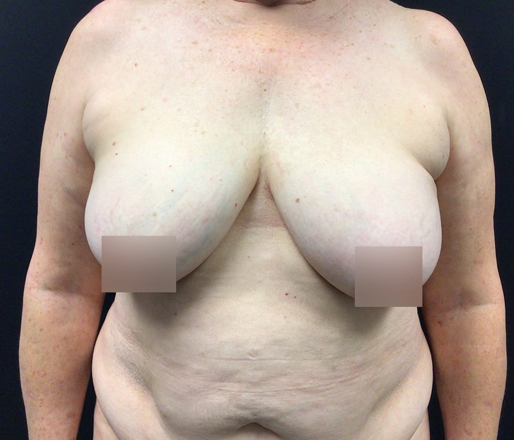 Breast Reduction Before & After Gallery - Patient 62142241 - Image 1
