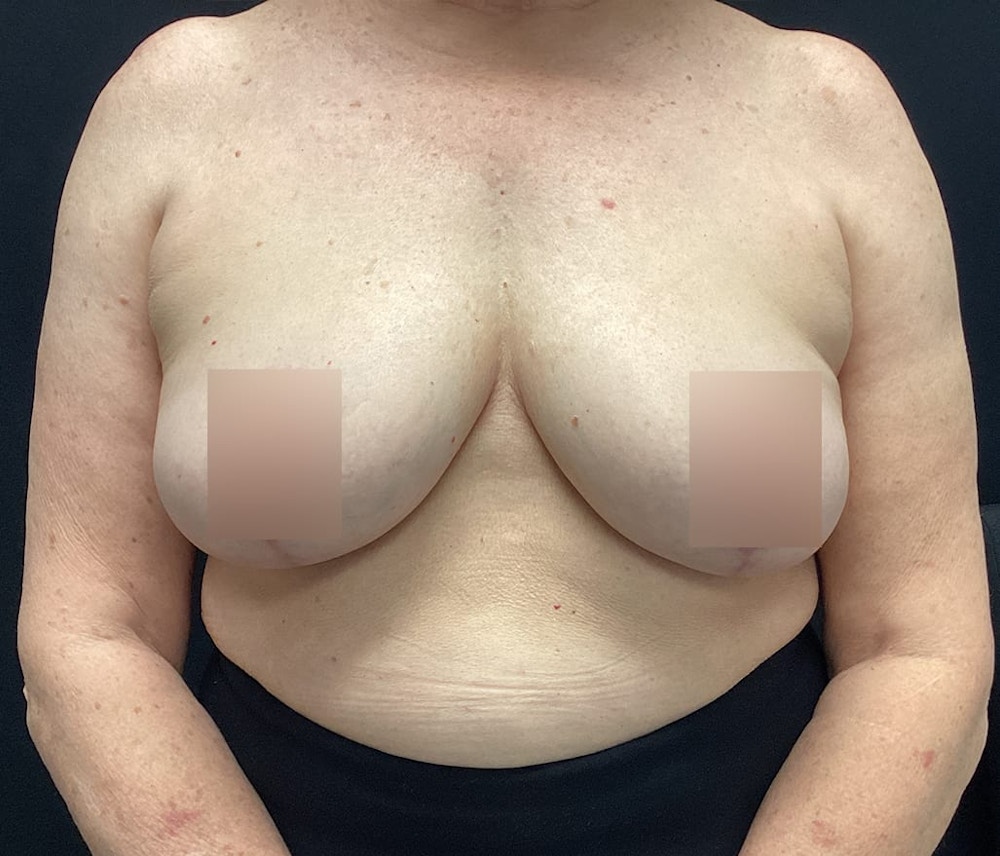Breast Reduction Before & After Gallery - Patient 62142241 - Image 2