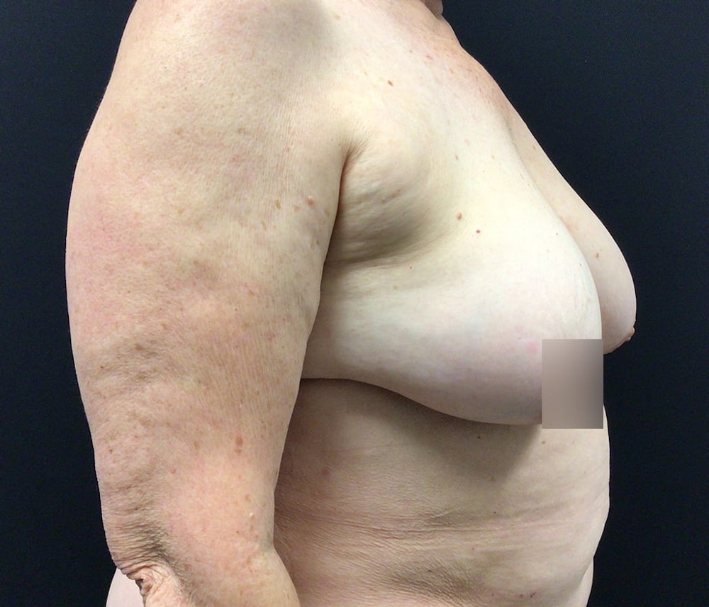 Breast Reduction Before & After Gallery - Patient 62142241 - Image 3