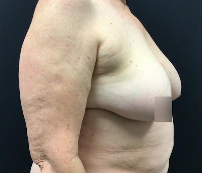 Breast Reduction Before & After Gallery - Patient 62142241 - Image 3
