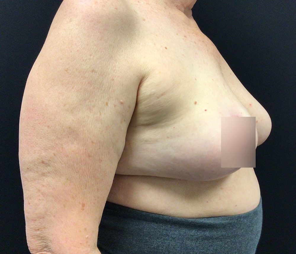 Breast Reduction Before & After Gallery - Patient 62142241 - Image 4