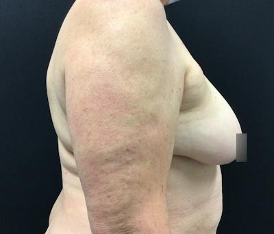 Breast Reduction Before & After Gallery - Patient 62142241 - Image 5