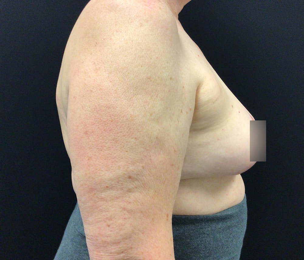 Breast Reduction Before & After Gallery - Patient 62142241 - Image 6