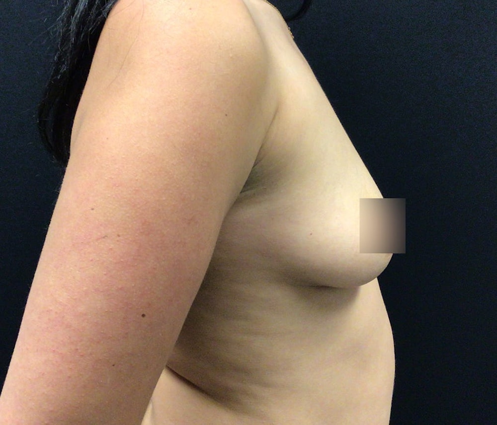 Breast Augmentation Before & After Gallery - Patient 62150341 - Image 5
