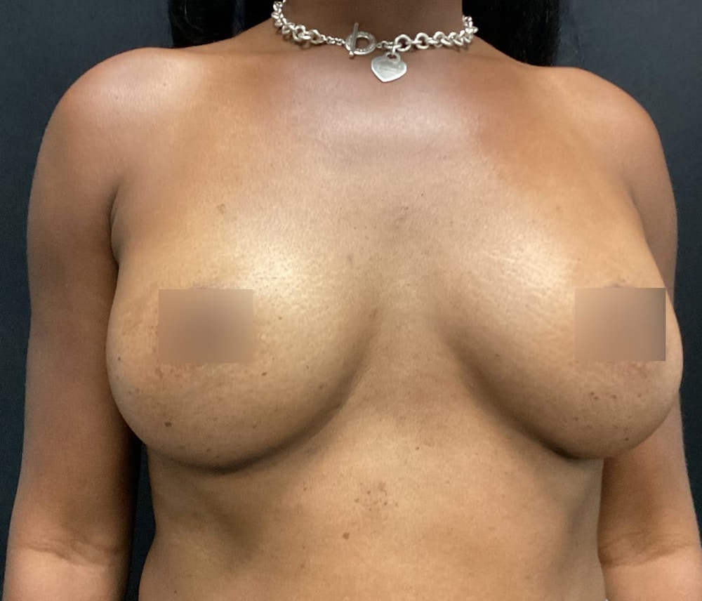 Breast Augmentation Before & After Gallery - Patient 62153201 - Image 2