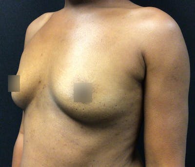 Breast Augmentation Before & After Gallery - Patient 62153201 - Image 3