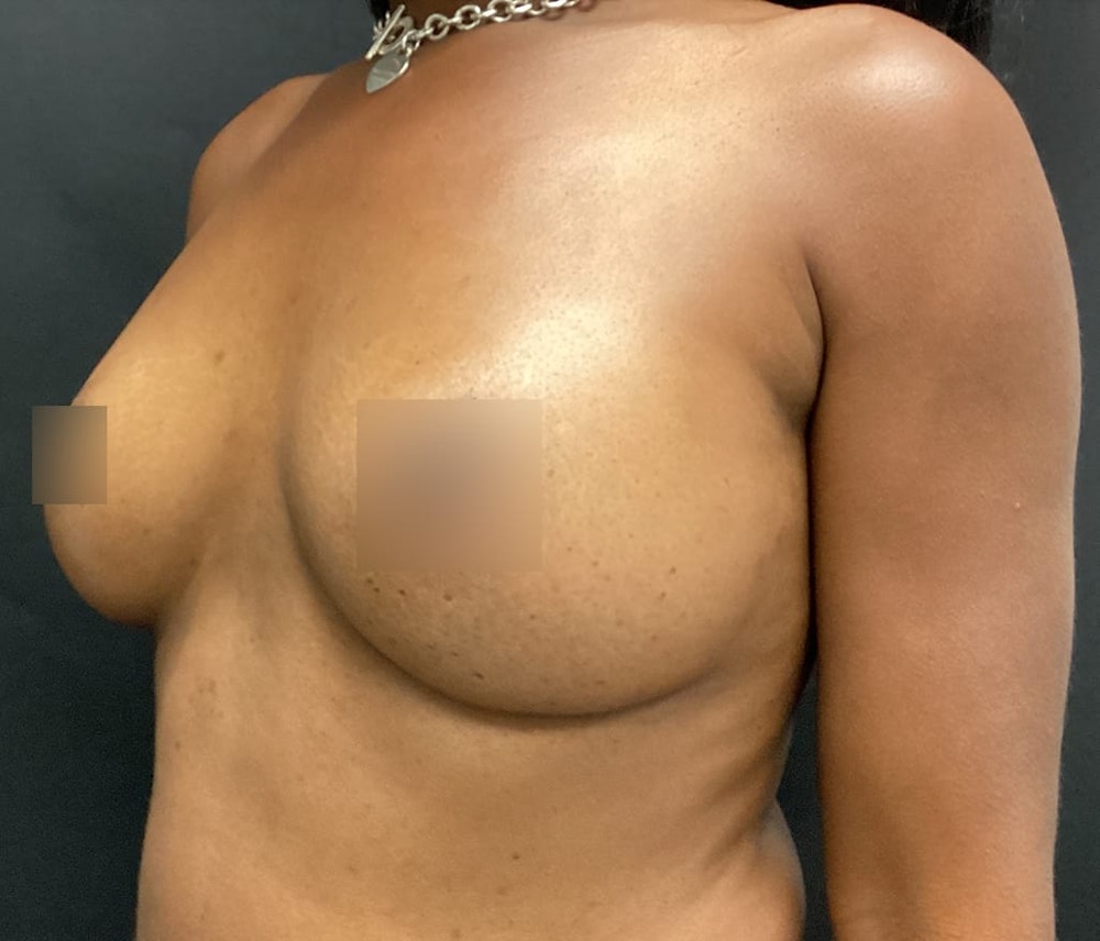 Breast Augmentation Before & After Gallery - Patient 62153201 - Image 4