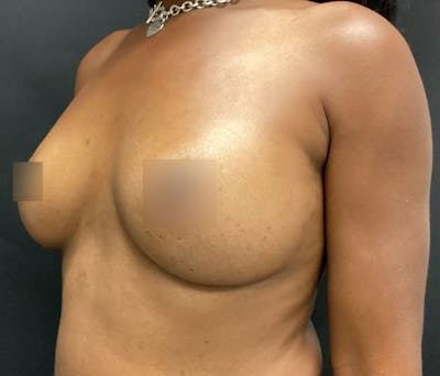 Breast Augmentation Before & After Gallery - Patient 62153201 - Image 4