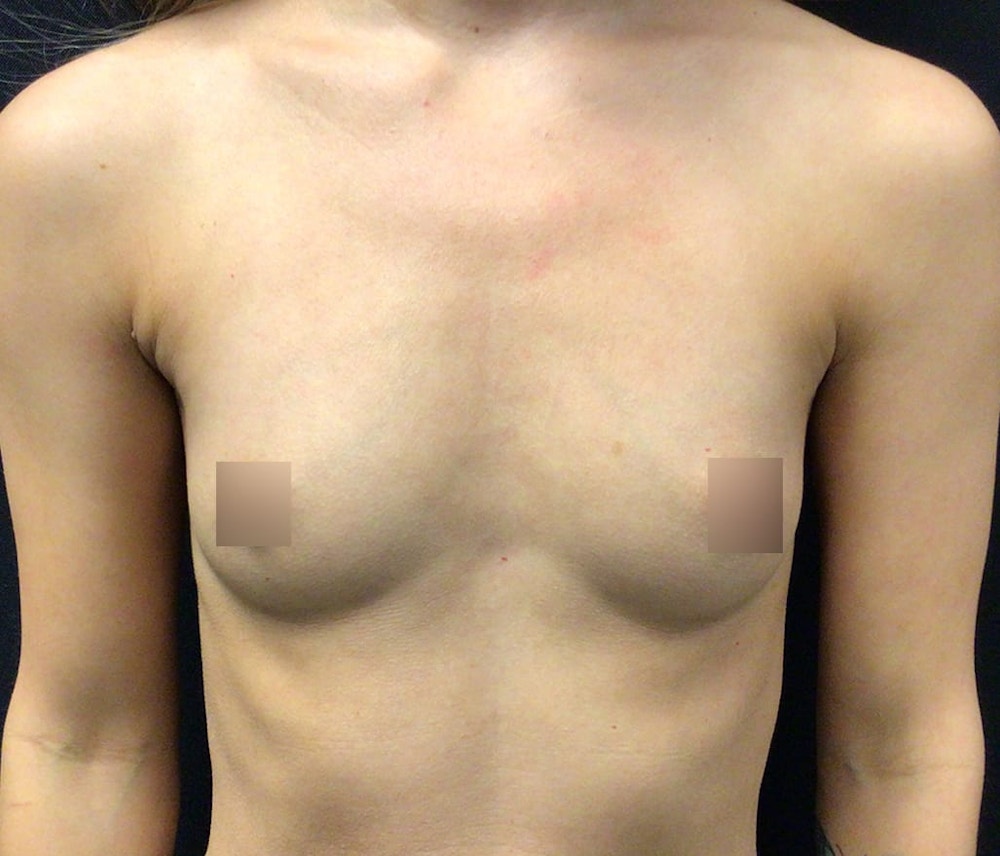 Breast Augmentation Before & After Gallery - Patient 62153385 - Image 1