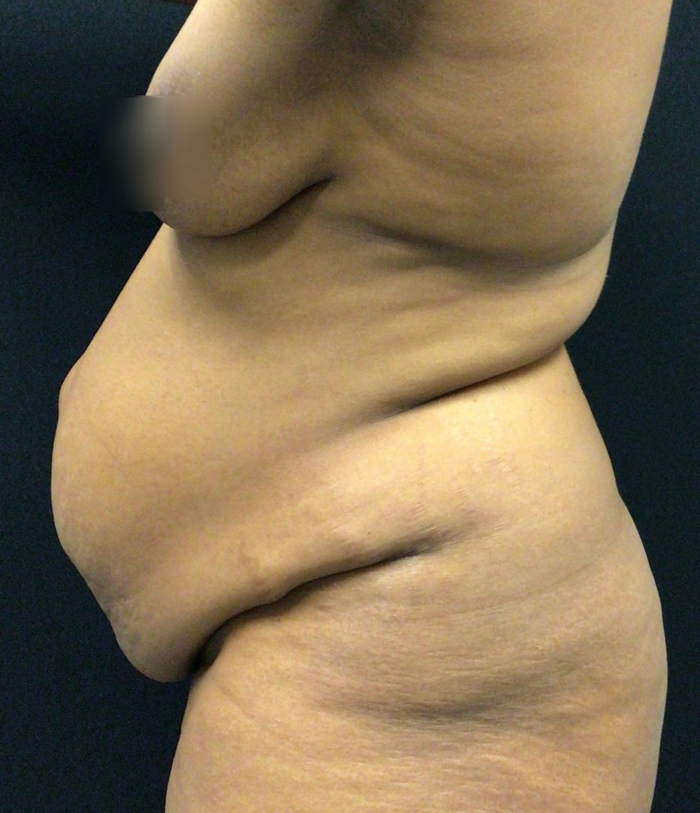 Liposuction Before & After Gallery - Patient 72243588 - Image 5