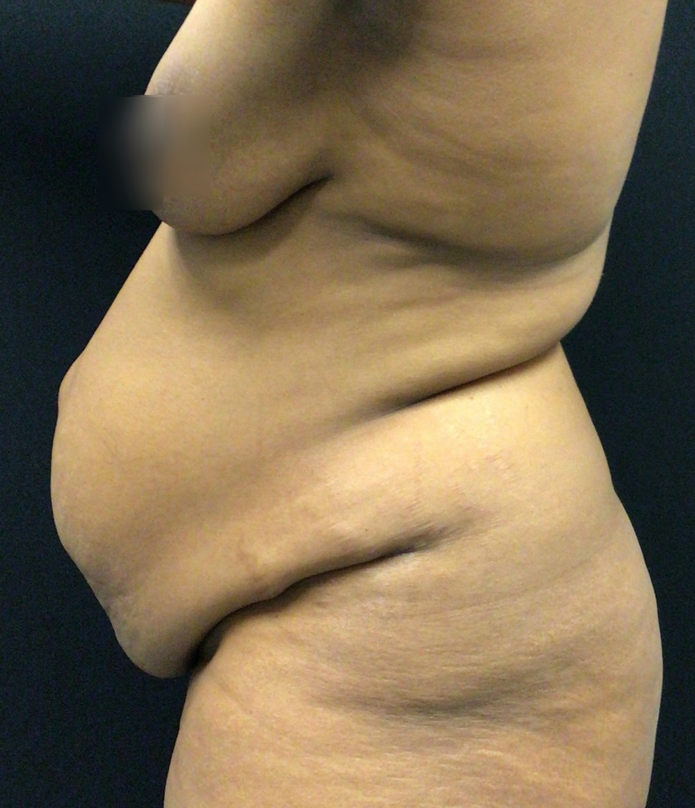 Lipo 360 Before & After Gallery - Patient 72243588 - Image 5