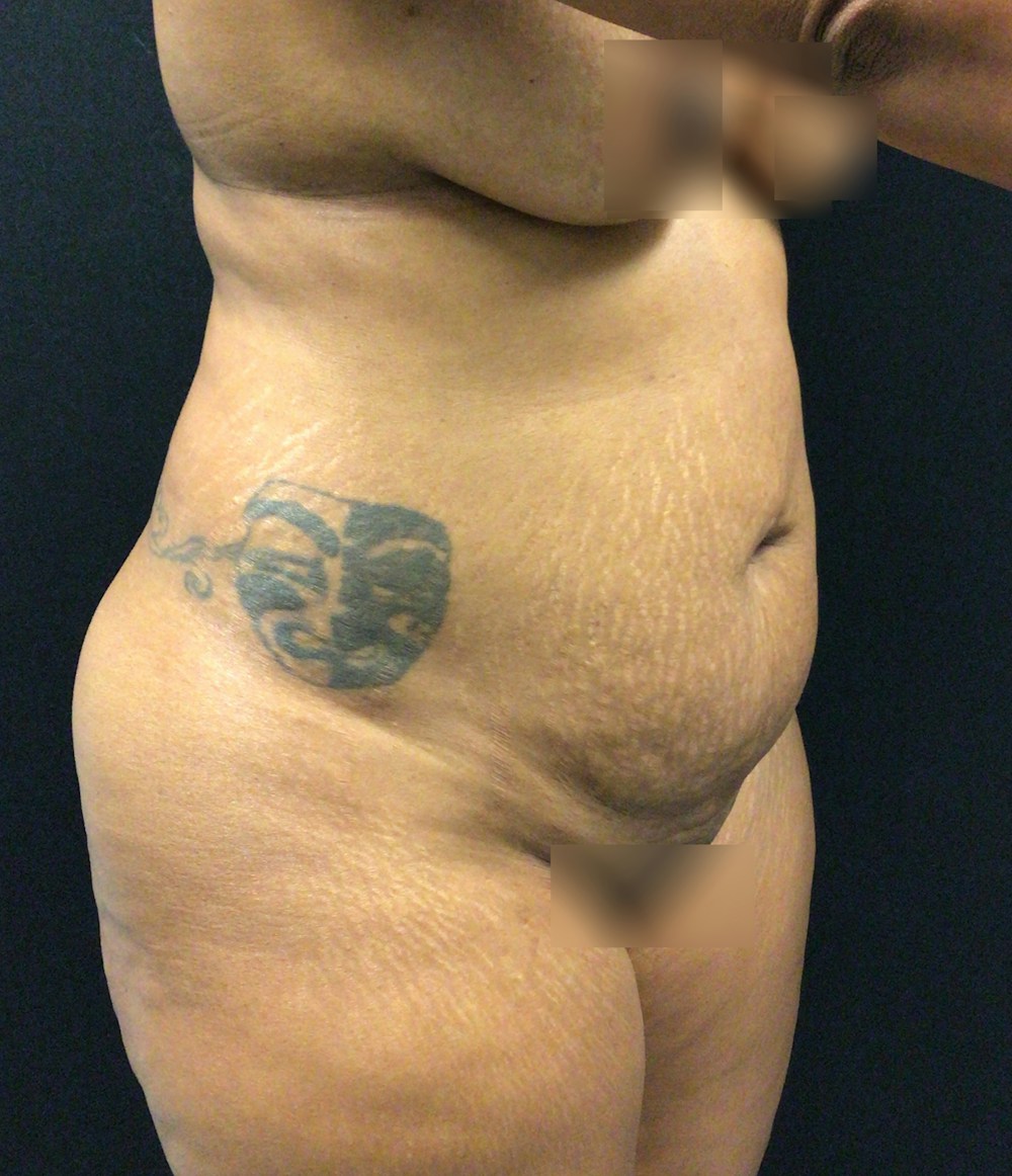 Tummy Tuck Before & After Gallery - Patient 58242844 - Image 3