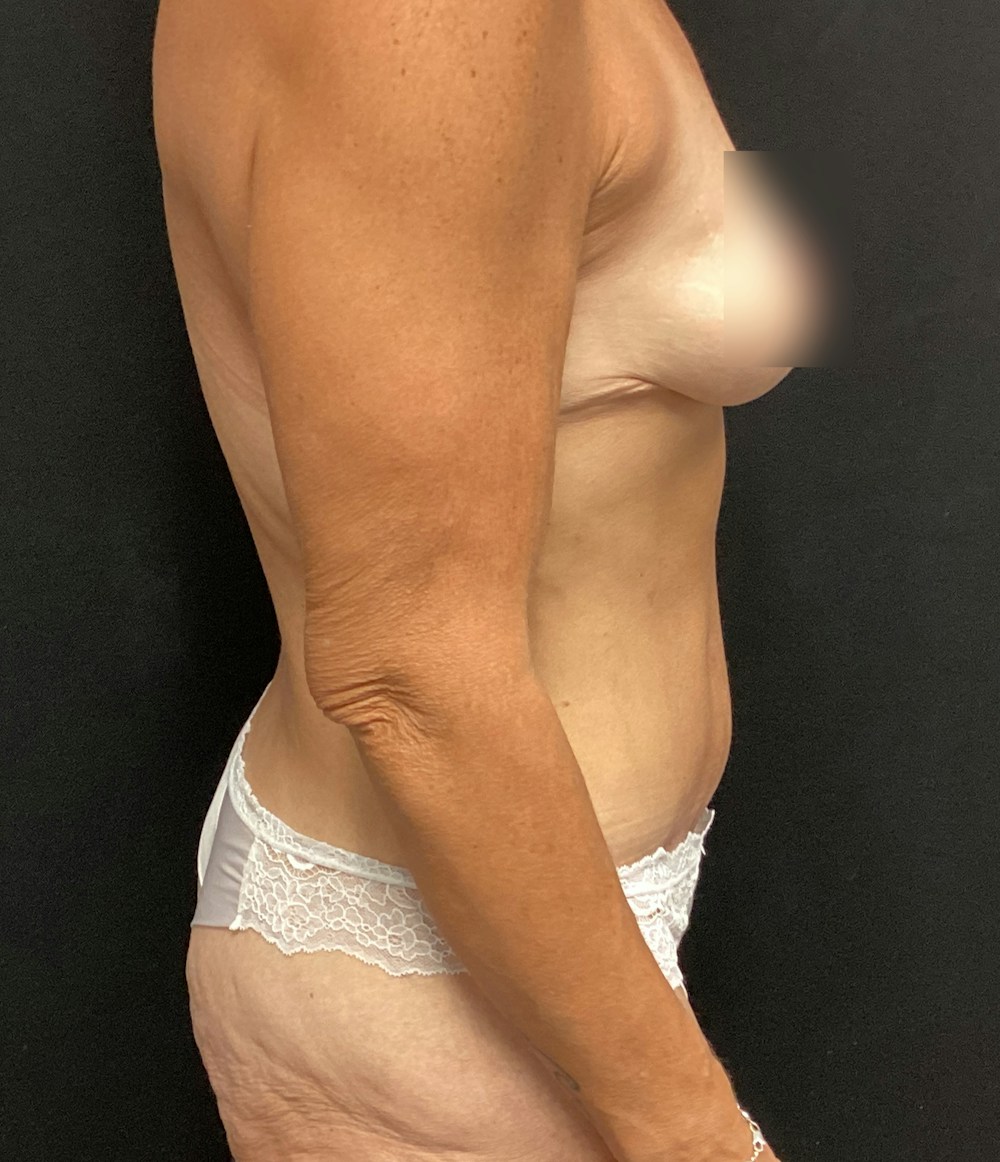 Tummy Tuck Before & After Gallery - Patient 58242609 - Image 6